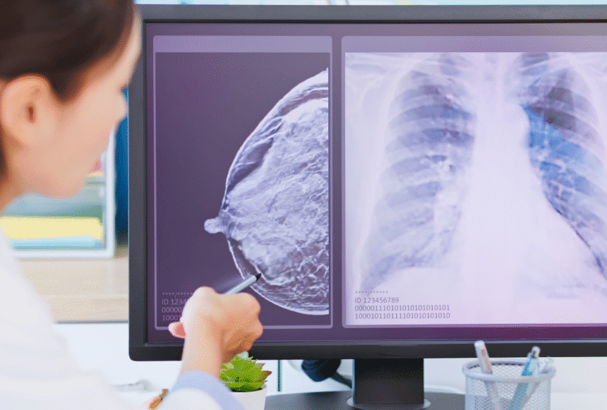 AI lung cancer screening