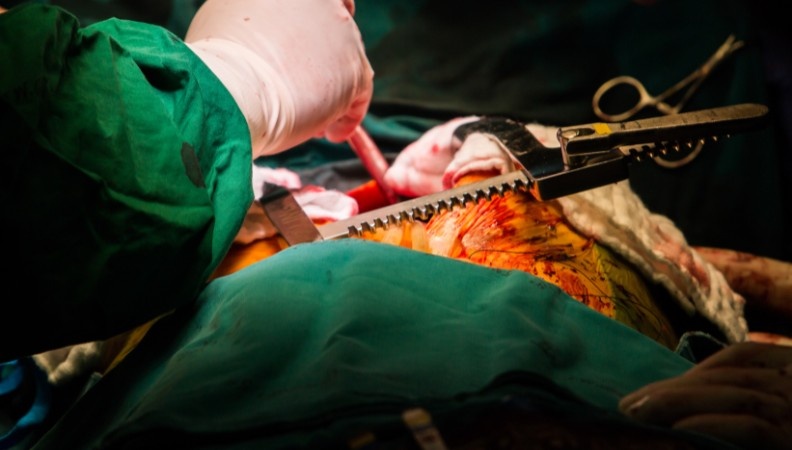 Coronary Artery Bypass ICD-10