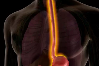 Illustration of the stomach and small intestine, highlighting the surgical repair of esophageal atresia and tracheoesophageal fistula.