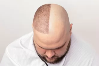 A bald man with a shaved head gazes downward, reflecting on his hair transplantation journey.