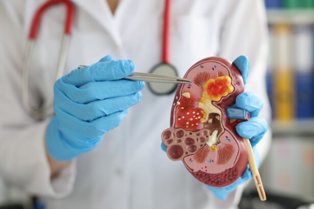 Kidney transplant surgery being performed by a skilled medical team