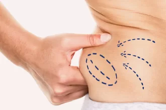 A person holds a blue arrow on their stomach, symbolizing the results of liposuction and body contouring.